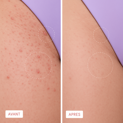 Lumismooth - Solution Lissante Anti-Poils Incarnés