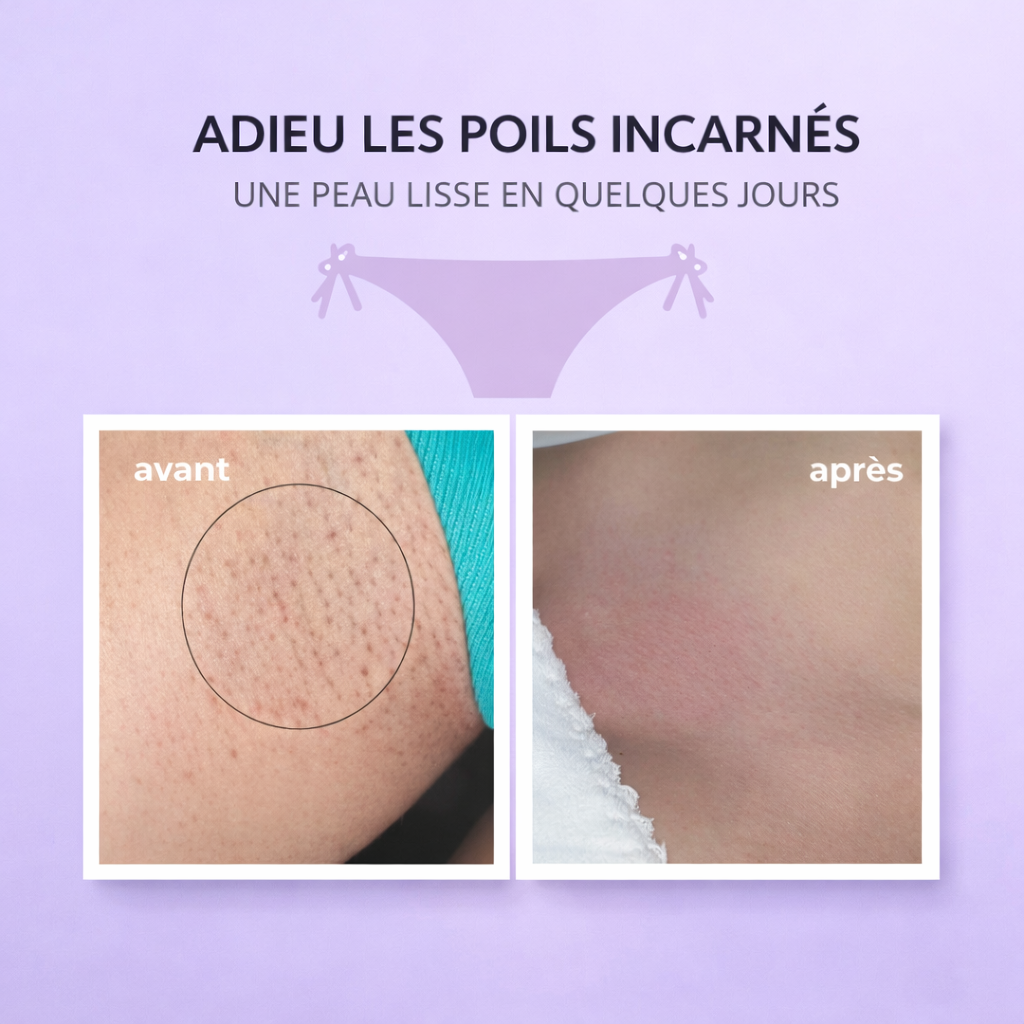 Lumismooth - Solution Lissante Anti-Poils Incarnés