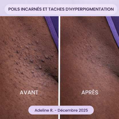 Roll-On Anti-Poils Incarnés et Taches