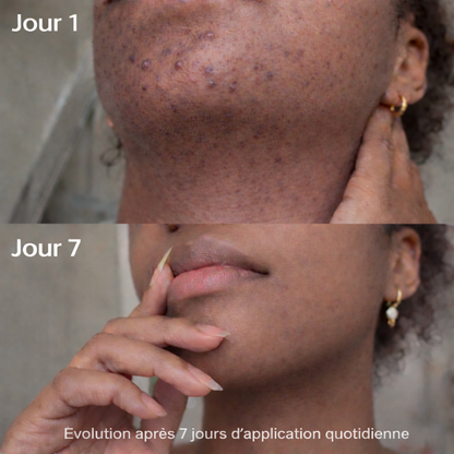 Roll-On Anti-Poils Incarnés et Taches